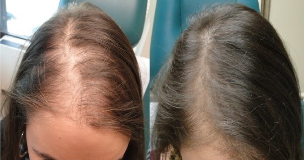 Lysienie - objawy i zapobieganie z Hairstim
